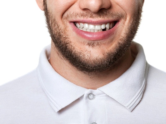 Man with a missing tooth