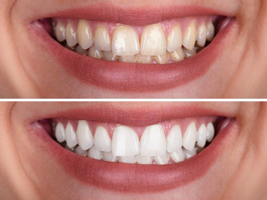 close up smile before and after teeth whitening 