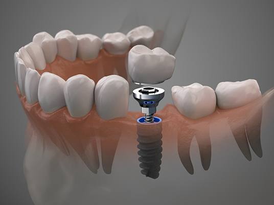 illustration of how dental implants work in Arlington 