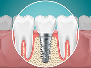 illustration of a dental implant merging with the jawbone 