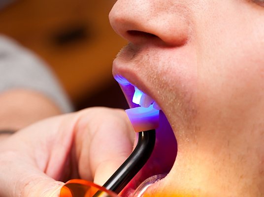 Special dental light for cosmetic bonding procedure.