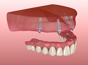 Diagram showing how implant dentures in Arlington work