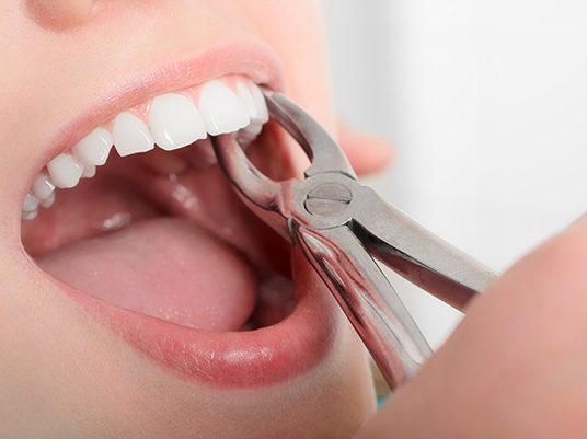 a person undergoing tooth extraction in Arlington