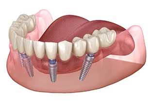 Diagram showing how implant dentures in Arlington work