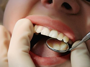 Closeup of patient during their dental checkups and cleanings in Arlington