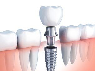 Diagram showing single tooth dental implant in Arlington 