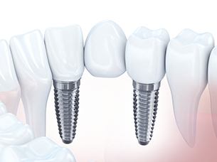 Diagram showing implant denture replacing multiple missing teeth in Arlington 