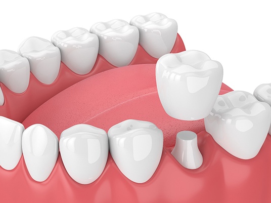 Model of a dental crown on a molar.