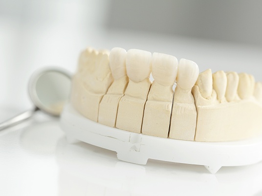 dental bridge mock up