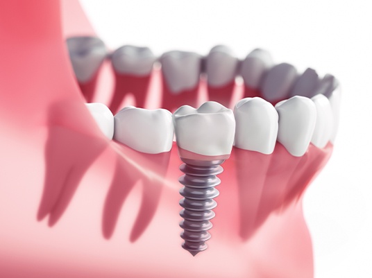 Computer illustration of dental implant