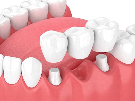 A diagram of a dental bridge.