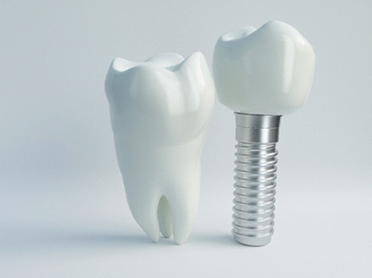 A model of a dental implant.