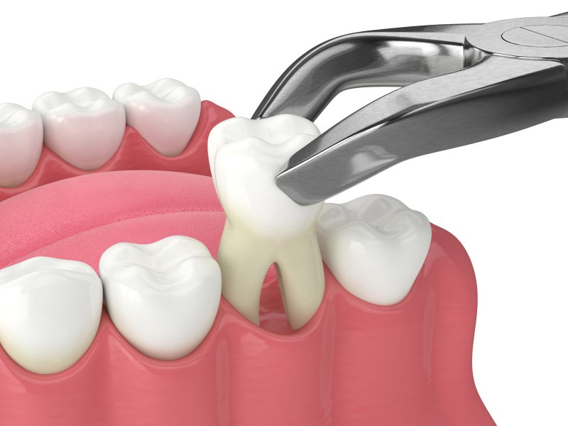 3D model of a tooth extraction